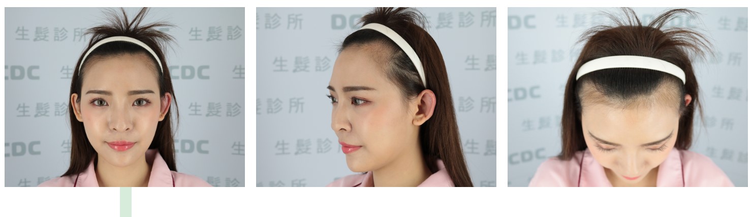髮際線手術前看起來比較顯老